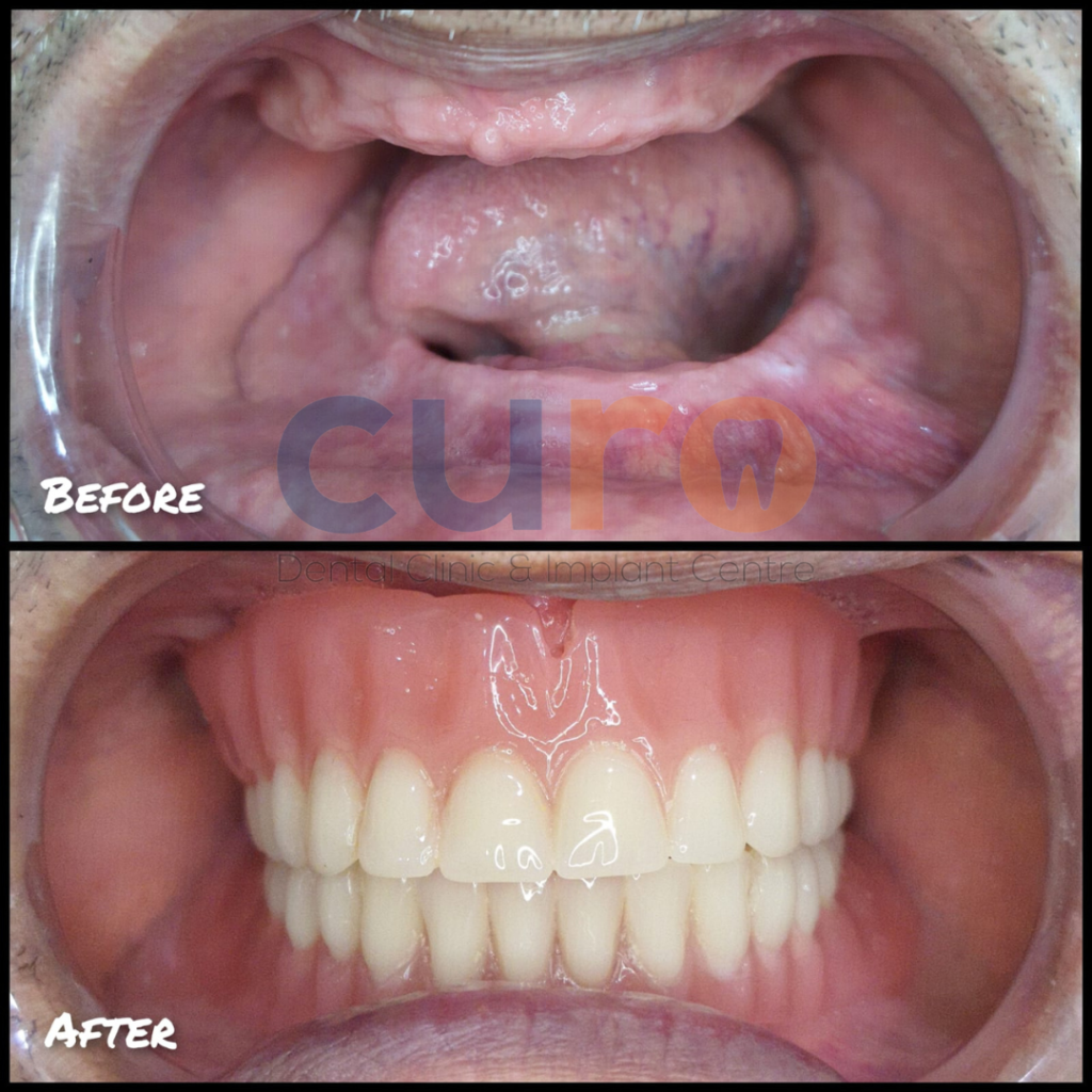 complete-dentures-curo-dental-ravet