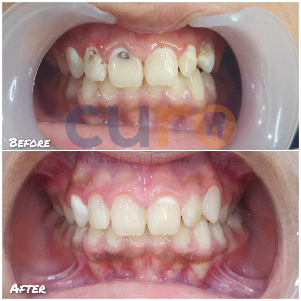 composite-curo-dental-ravet