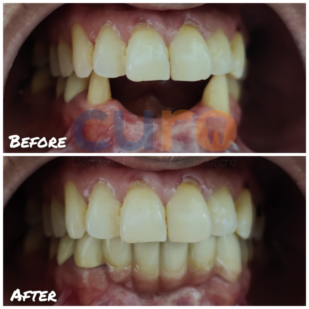 crown & Bridges at curo dental clinic in kiwale ravet pune