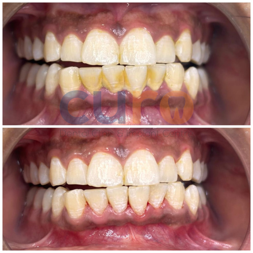 scaling-teeth-at curo-dental-clinic-ravet