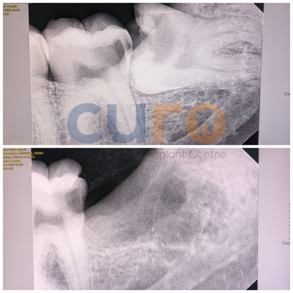 wisdom-tooth-removal-curo-dental-ravet